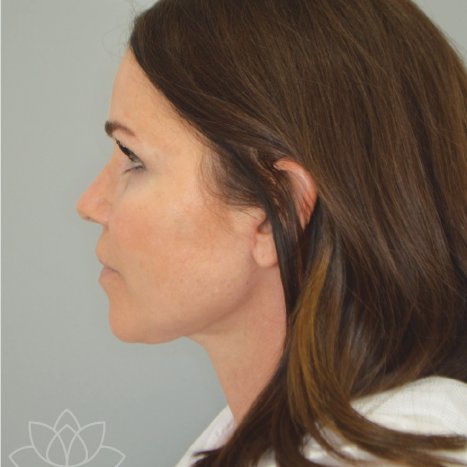 submental liposuction to treat a double chin